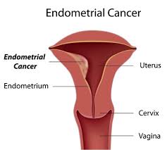 Uterine Cancer and Late Menopause