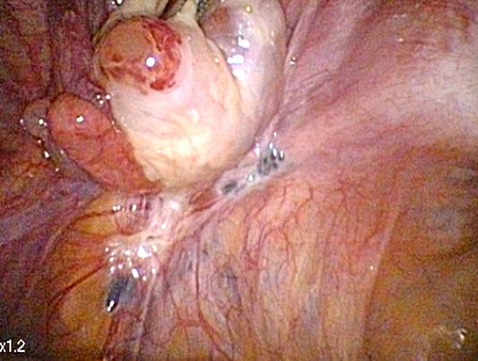 DIAGNOSING ADOLESCENT ENDOMETRIOSIS