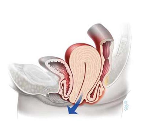 THE MODE OF DELIVERY VERSUS VAGINAL PROLAPSE